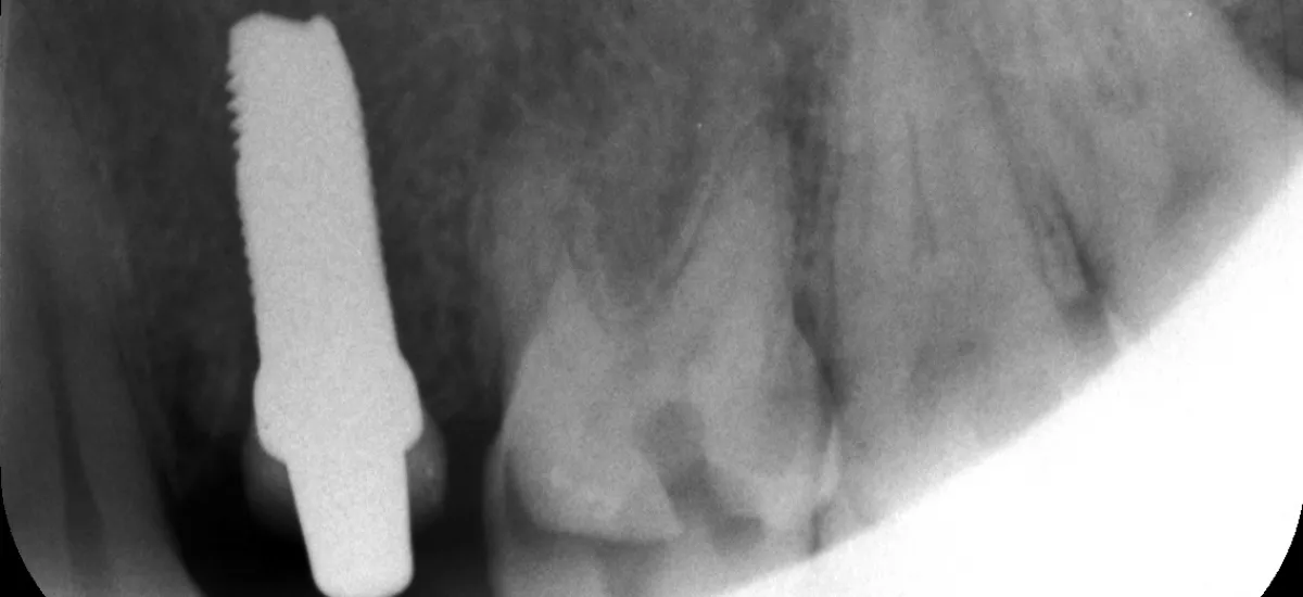 PLACEMENT IMPLANT CERAMIQUE