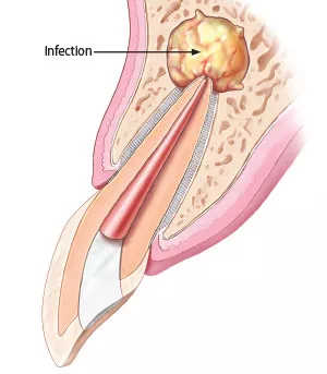 apicoectomy-root-canal-reinfected.jpg